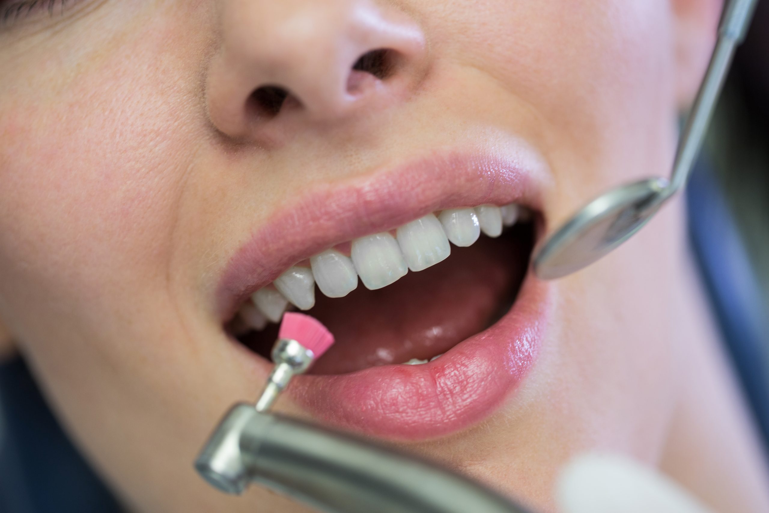 Limpieza Dental